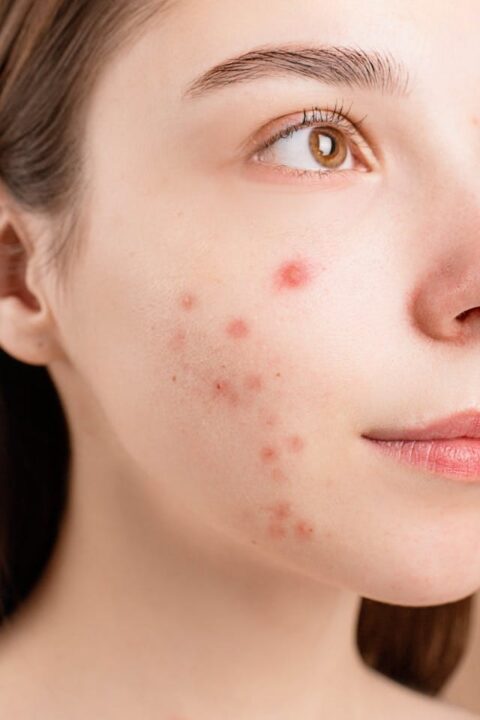 7 Mistakes When Treating Acne