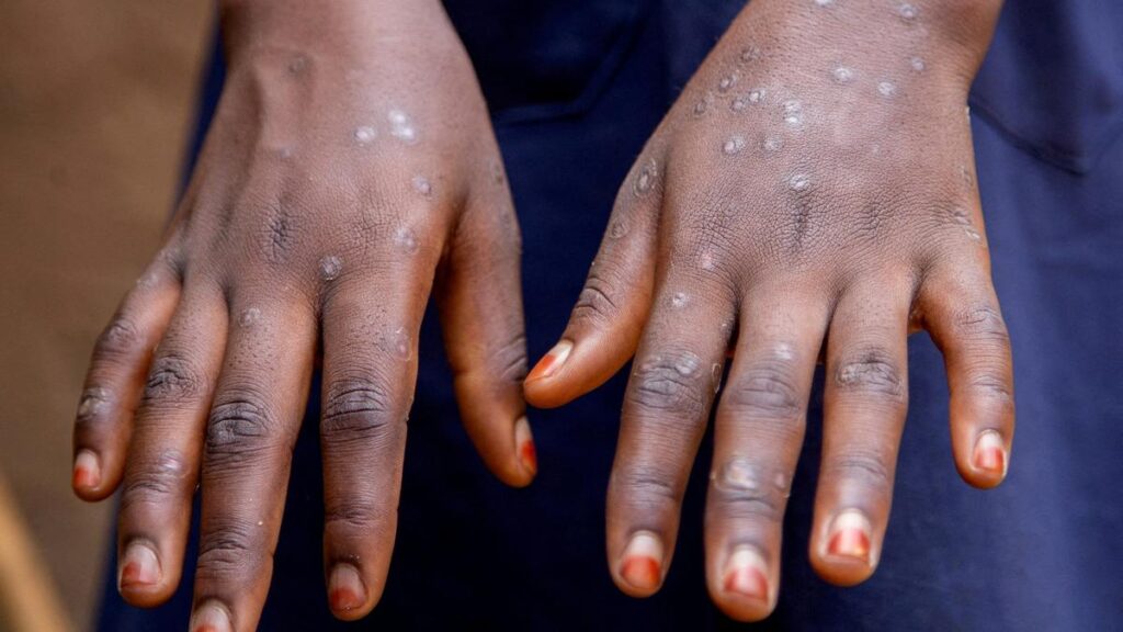 Sex work drives clade Ib mpox outbreak in DR Congo