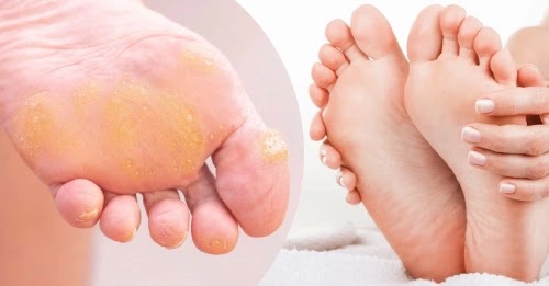 Home Remedies to Remove Corns on Feet Overnight Naturally