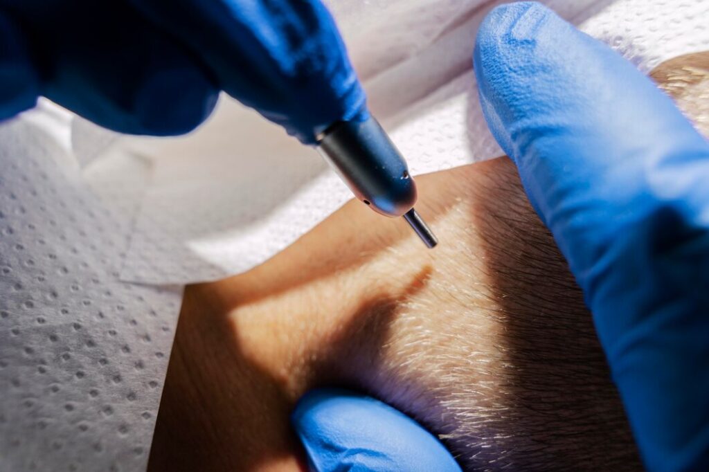 Laser Tattoo Removal