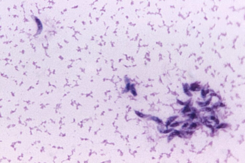 Toxoplasmosis Gondii