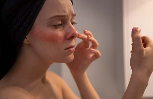 Acne Treatment
