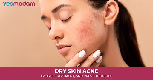Dry Skin Acne